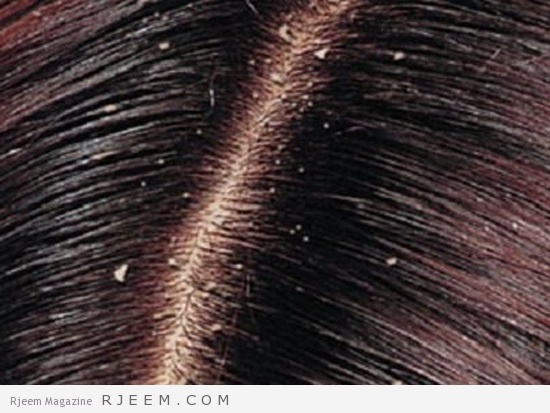التخلص من فطريات الشعر - علاج مشكلة فطريات الشعر
