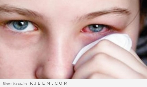 أسباب وأعراض وطرق علاج الدموع المستمرة في العين