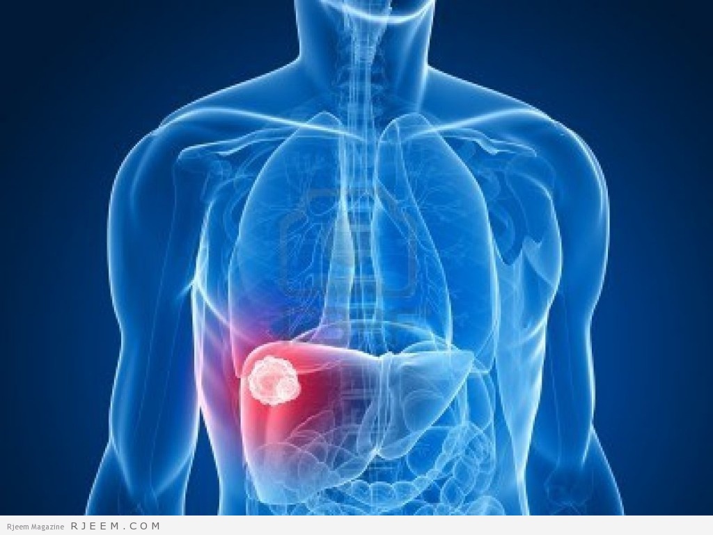 الكبد - مرض التهاب الكبد 
