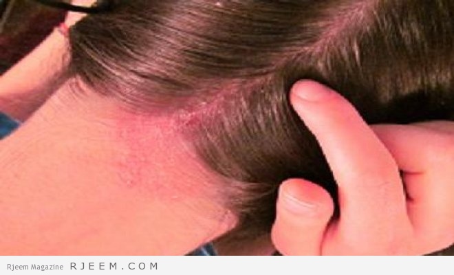 اكثر من 5 خلطات علاج فروة الراس عالج فروة رأسك بطرق طبيعية و سليمة مجلة رجيم