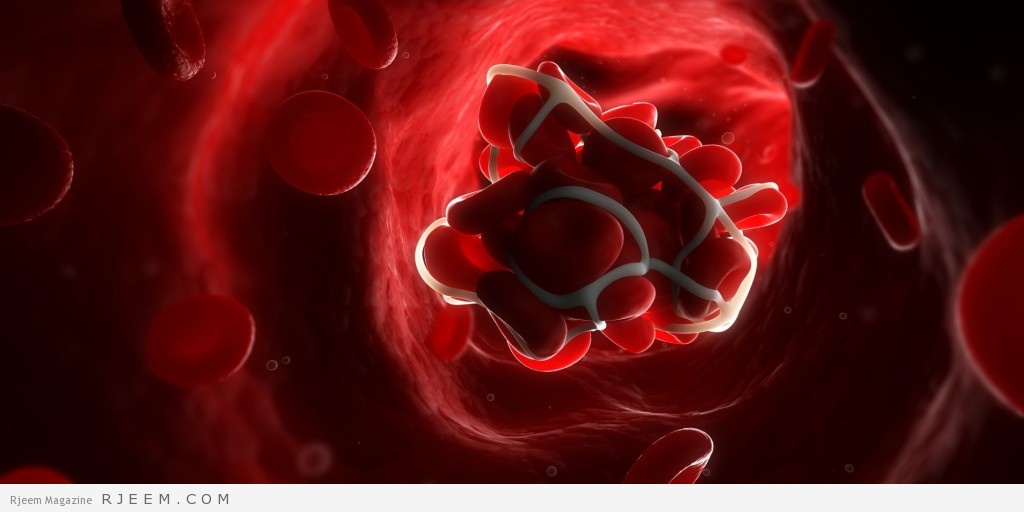 تخثر الدم - اسباب وعلاج فرط الخثورية