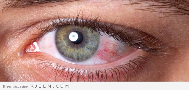 اسباب و اعراض ارتفاع ضغط العين