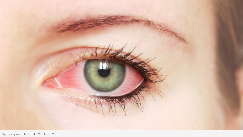 اسباب و اعراض ارتفاع ضغط العين