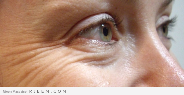 20 خلطة طبيعية لعلاج تجاعيد الوجه وحول العين