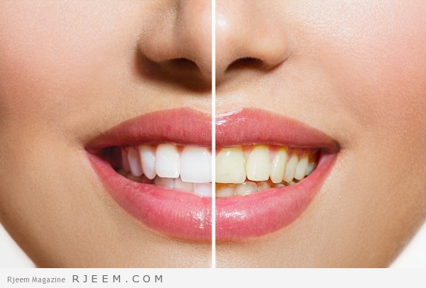 15 طريقة طبيعية لازالة اصفرار الاسنان 