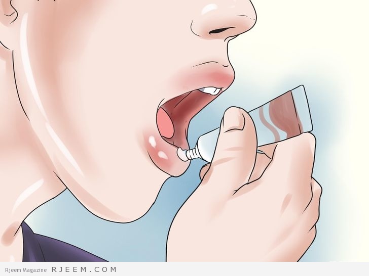 16 علاج منزلي لتقرحات الفم