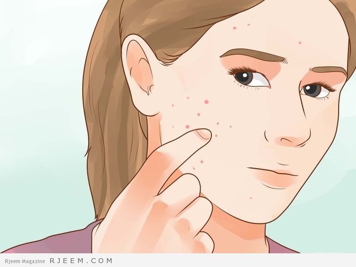 4 طرق لازالة حفر الوجه بعد علاج حب الشباب