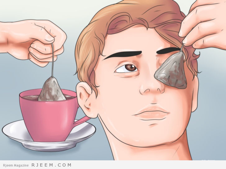 10 طرق لعلاج انتفاخ العين منزليا