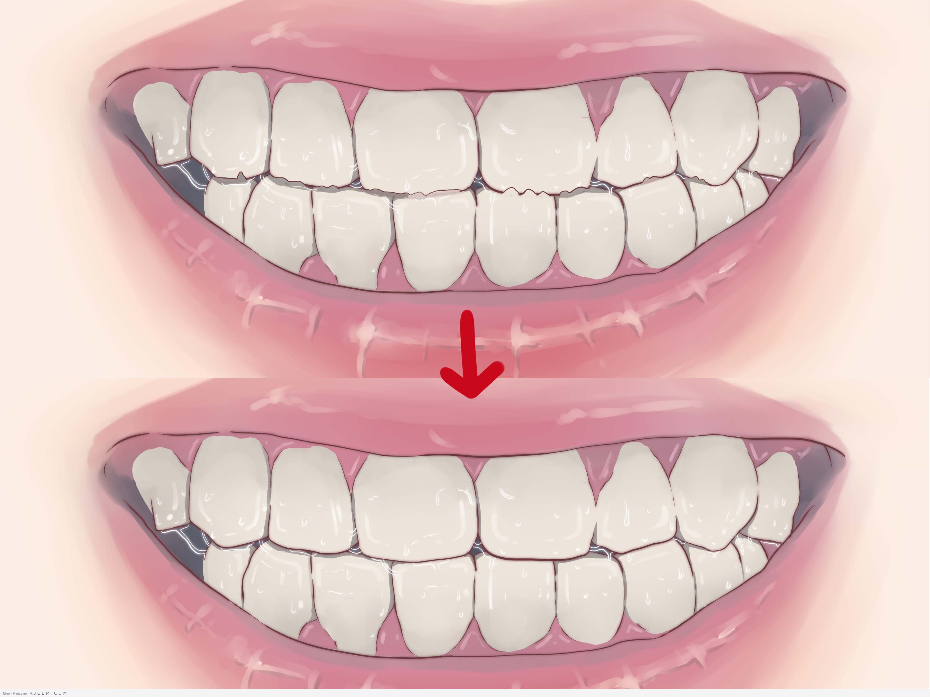 6 طرق طبيعية لمنع تسوس الاسنان