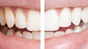 3 طرق مجربة  لتبييض الاسنان طبيعيا 