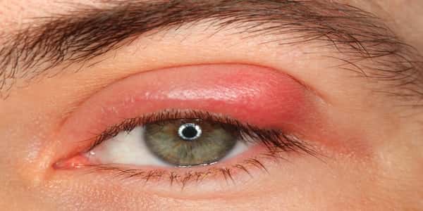 كيفية علاج التهاب جفن العين