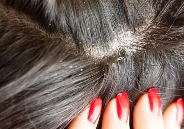 أفضل 10 مكونات طبيعية لعلاج قشرة الشعر الصعبة