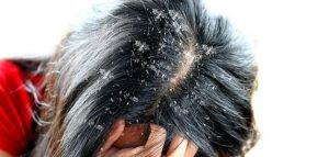 أفضل 5 نصائح لعلاج قشرة الشعر