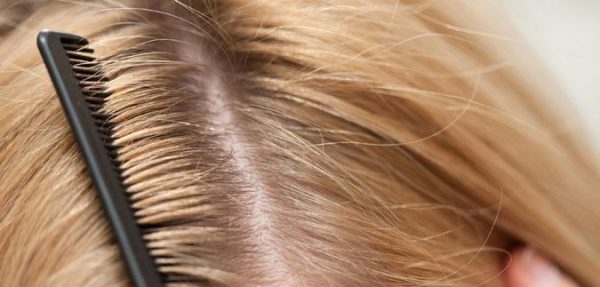 علاج طبيعي للتخلص من القشرة وتساقط الشعر