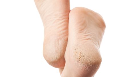 الطريقة الصحيحة لترطيب القدمين , علاج جفاف القدمين