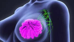 أعراض سرطان الثدي وأسبابه