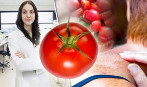 الطماطم لعلاج حروق والتهابات الشمس