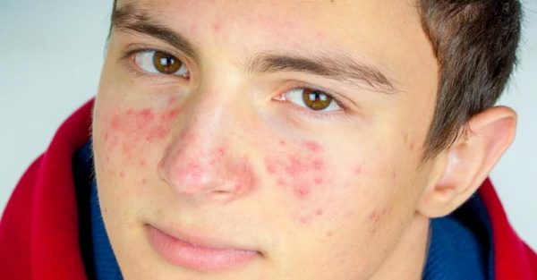 acne إزالة حب الشباب