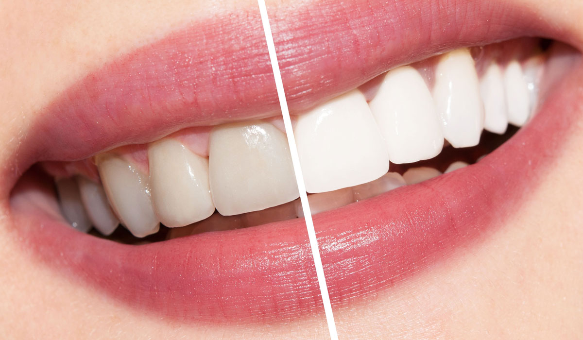 استخدام بيكربونات الصوديوم لتبييض الاسنان