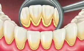 اضرار و فوائد تنظيف الجير من الأسنان