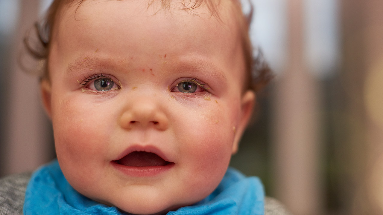علاج التهاب العين عند الاطفال بالاعشاب