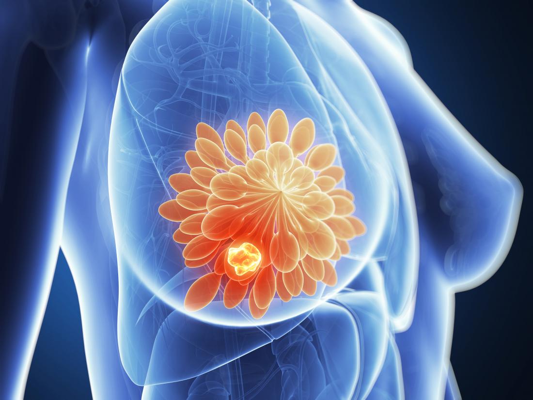 انواع سرطان الثدي الخبيث