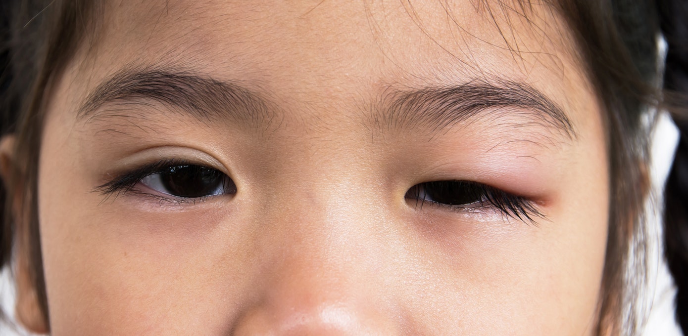 علاج انتفاخ جفن العين السفلي عند الأطفال