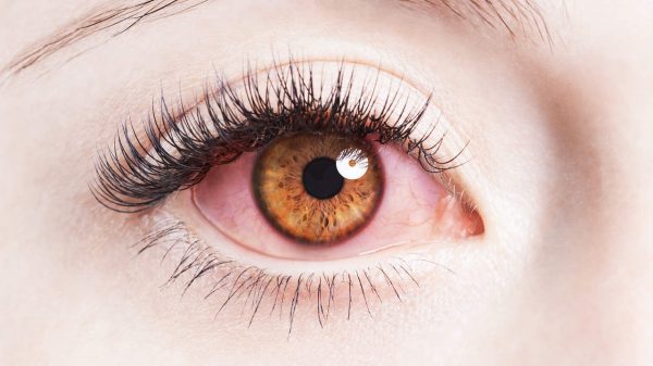 علاج احمرار العين بالاعشاب