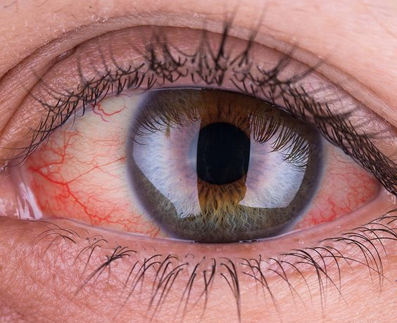 علاج احمرار العين في البيت - الوسط