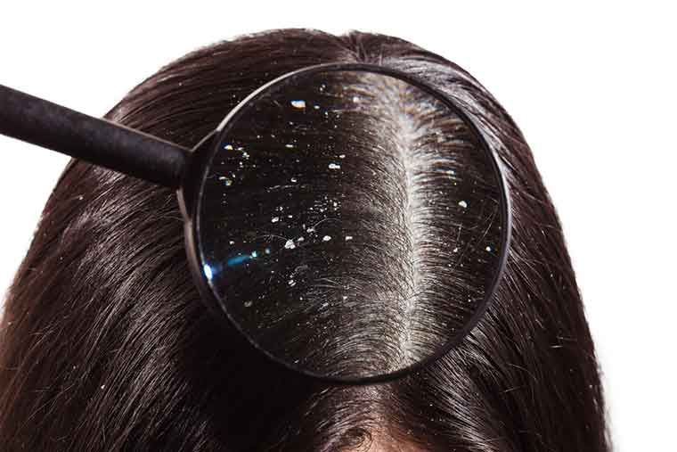 8 أسرع وصفات لعلاج قشرة الشعر