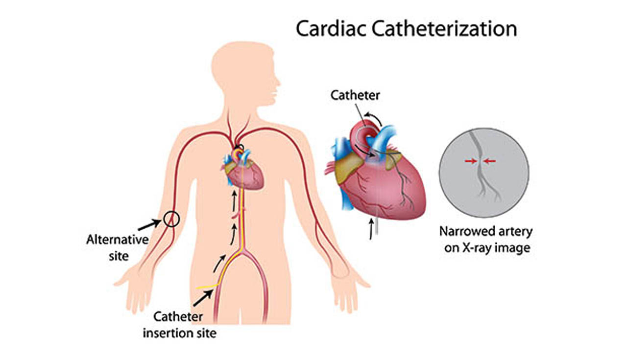 ما الفرق بين القسطرة القلبية والتصوير النووي