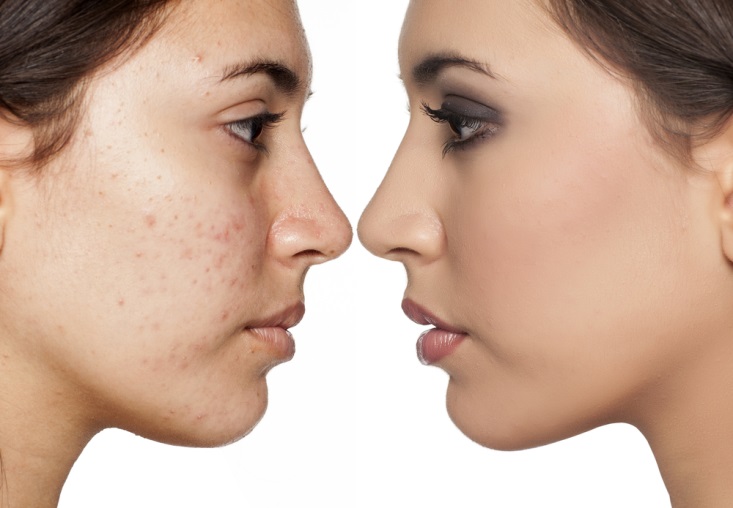10 وصفات لعلاج البقع السوداء على الوجه