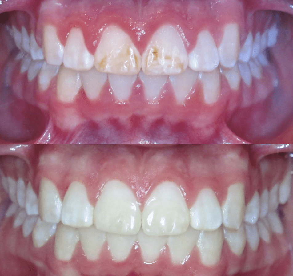 البقع البنية على الأسنان