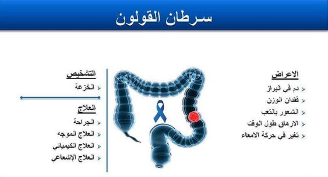 اعراض سرطان القولون