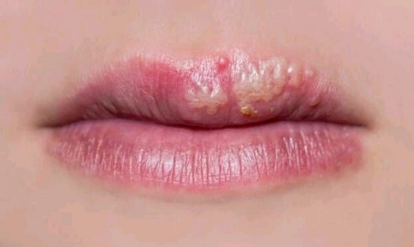 ما هو حمو الفم
