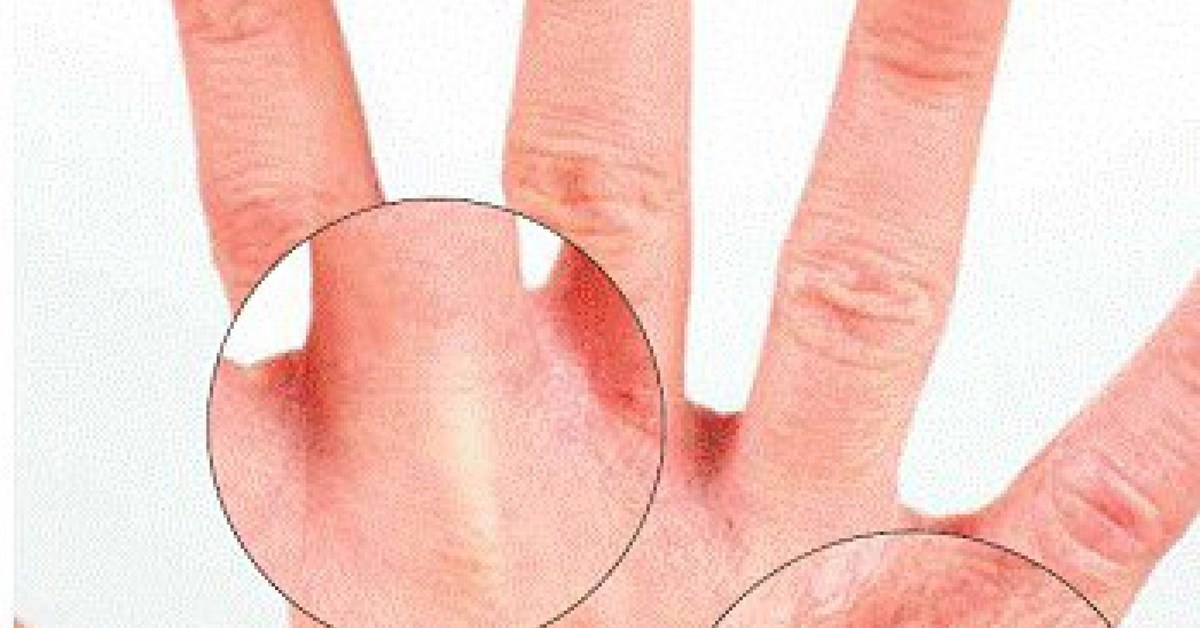 علاج التهاب بين الاصابع