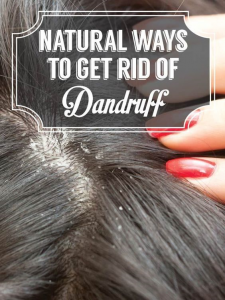 للتخلص من قشرة الشعر dandruff جربي هذه الوصفات فعالة ومذهلة