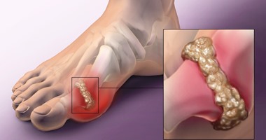 علاج النقرس واملاح القدم لتجنب نوبات النقرس والامه