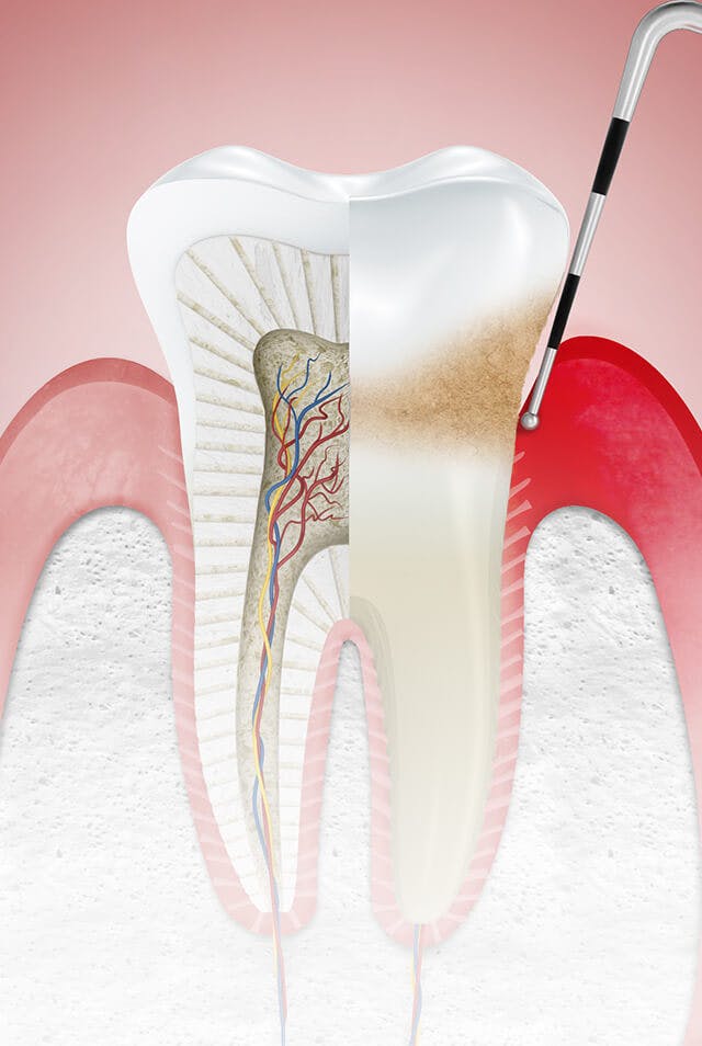 التهابات الفم و الاسنان للحامل